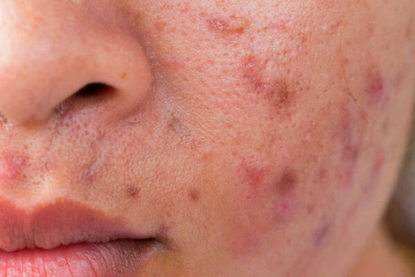 Creme antibrufoli e acne: quali sono quelle sicure